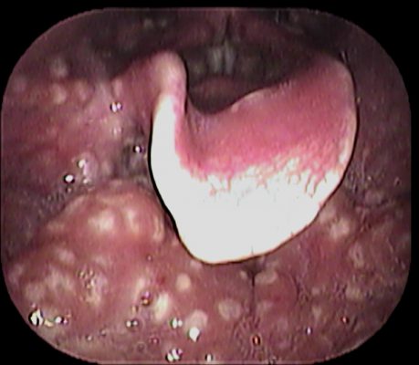 ウイルス性咽喉頭炎 いのうえ耳鼻咽喉科