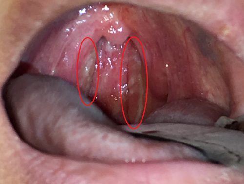 40 の熱 いのうえ耳鼻咽喉科