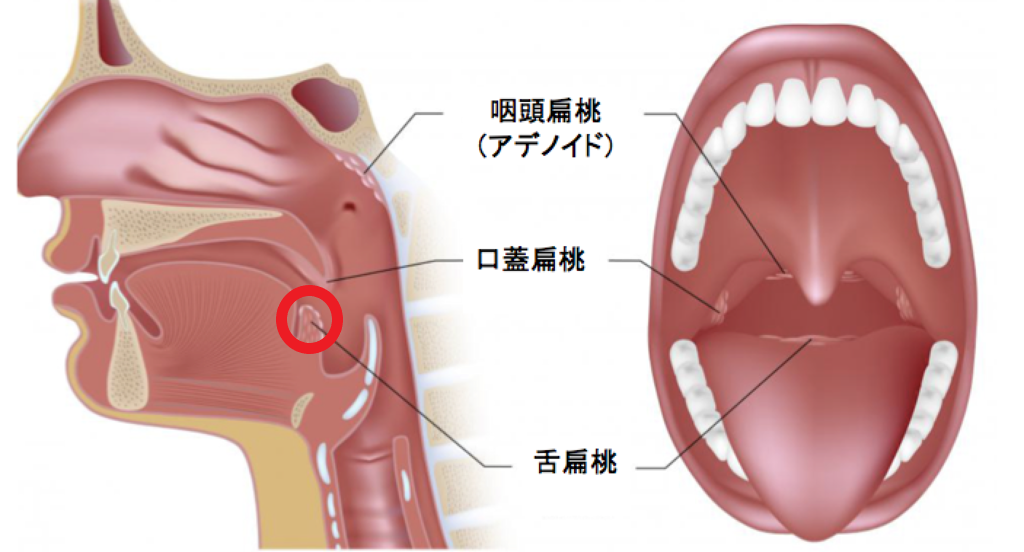 のどのイボ いのうえ耳鼻咽喉科