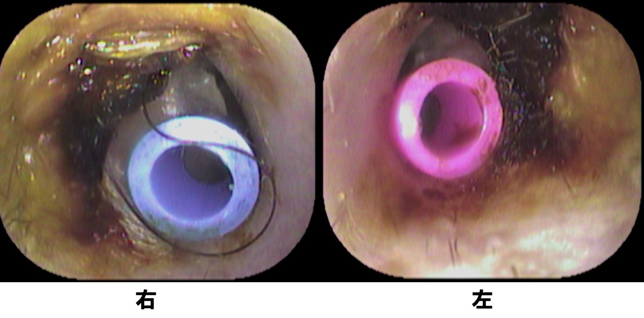カテゴリ 診療について のブログ記事 いのうえ耳鼻咽喉科